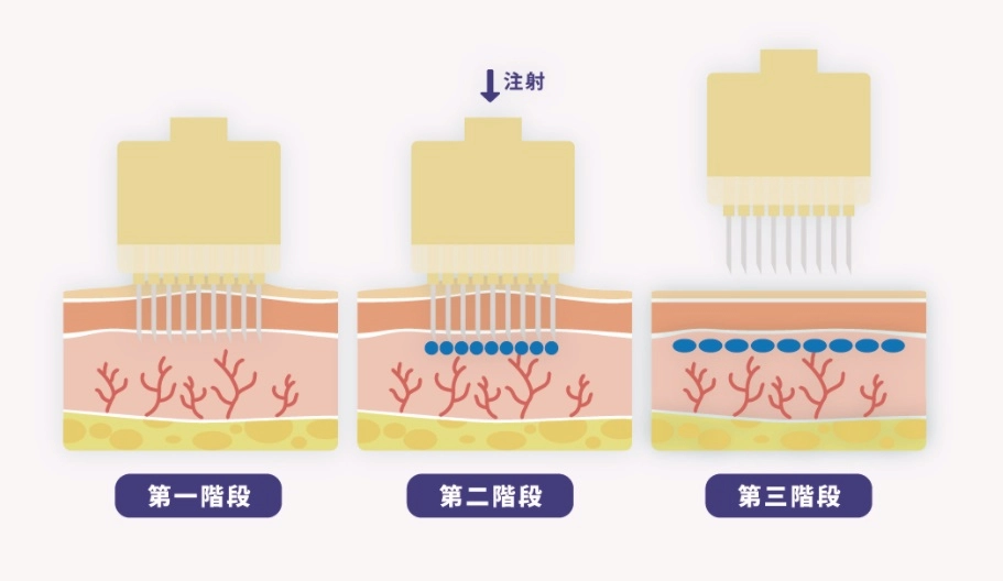 智能注射 智能注射